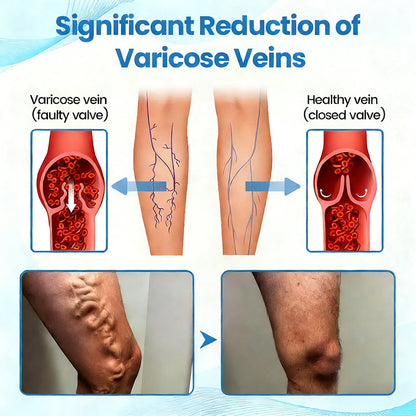 Fade Varicose & Spider Veins