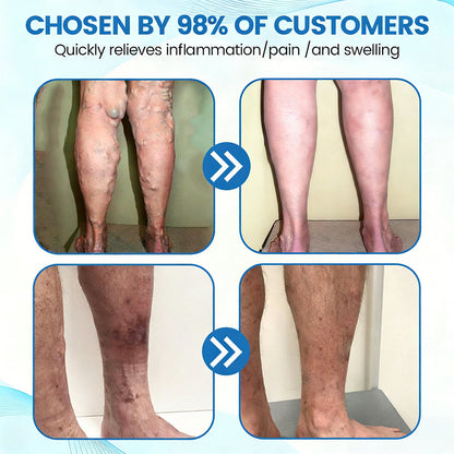 Fade Varicose & Spider Veins