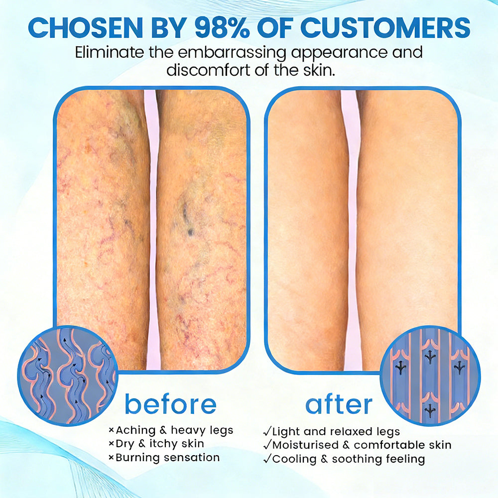 Fade Varicose & Spider Veins