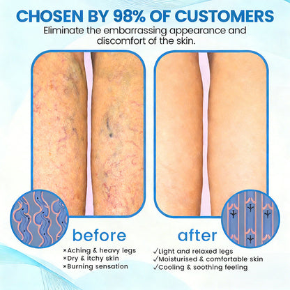 Fade Varicose & Spider Veins