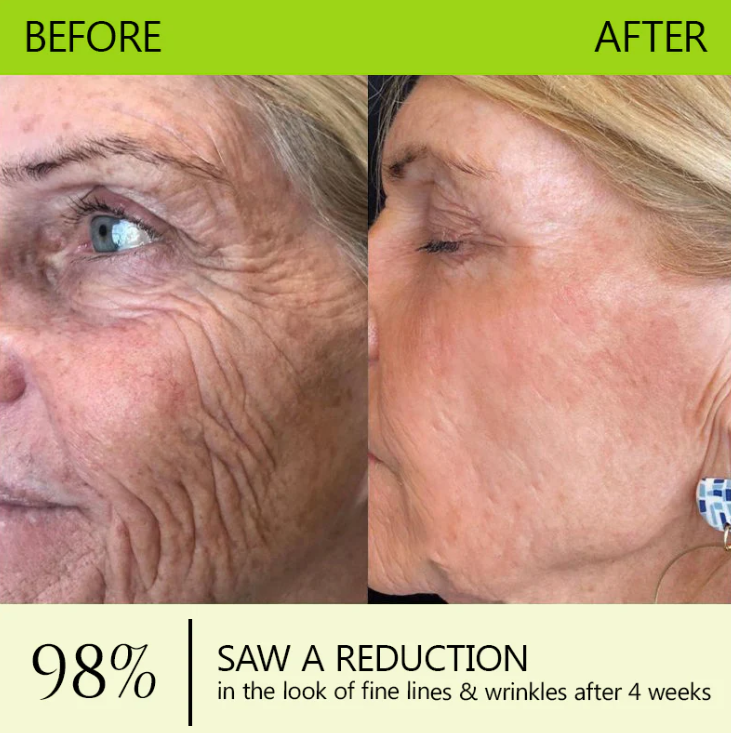 [🔥Last Day 51% OFF] ODALIT™ Botox & Retinol Shot - Eraser for Deep Wrinkles, Sagging Jowls & Puffy Eyes