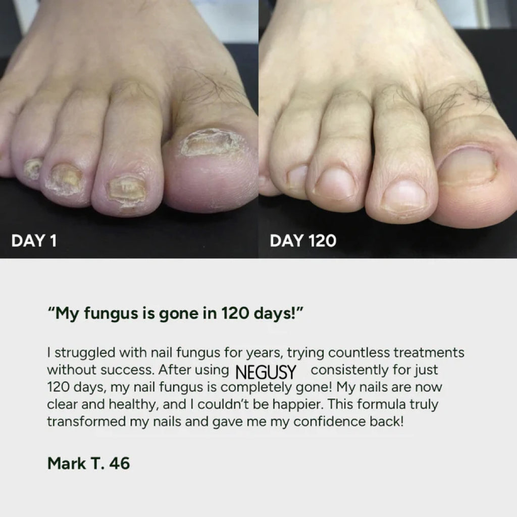 Nail Fungus Treatment Gel Limited Time 80%OFF 🔥LAST DAY⏰