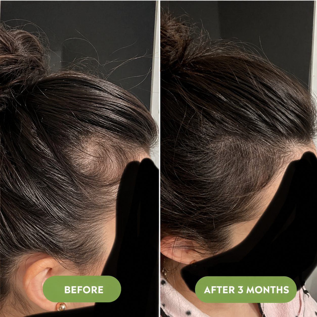 🔥Buy 2 Get 1 FREE + Free Shipping 🔥Advanced Hair Growth Serum