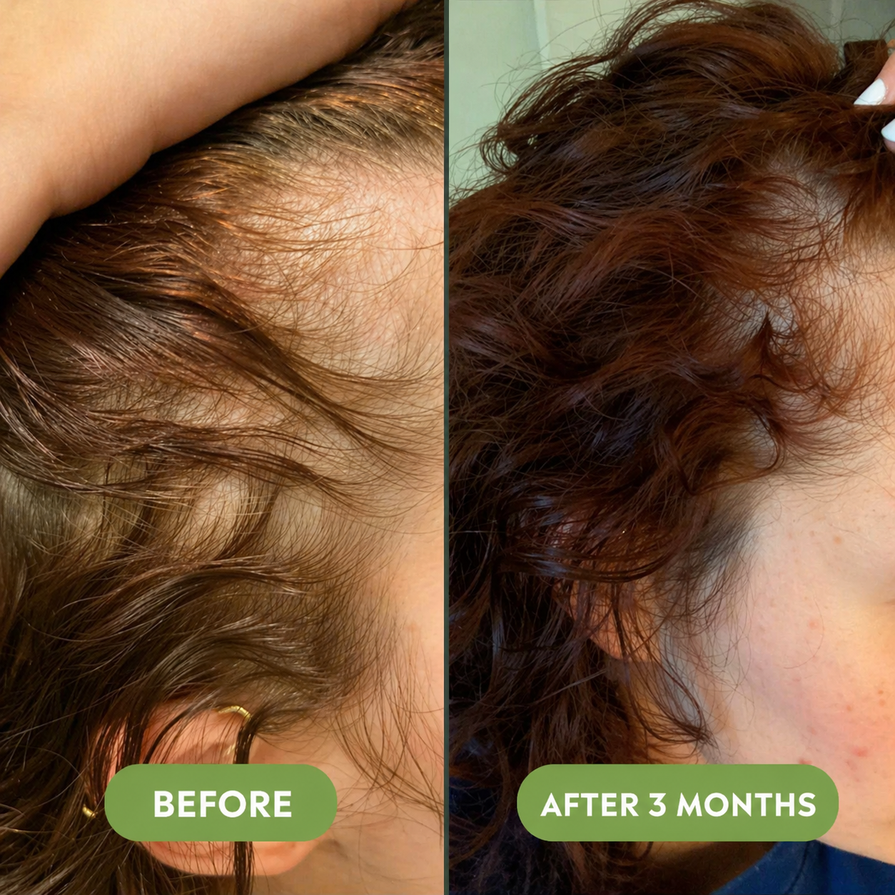 🔥Buy 2 Get 1 FREE + Free Shipping 🔥Advanced Hair Growth Serum