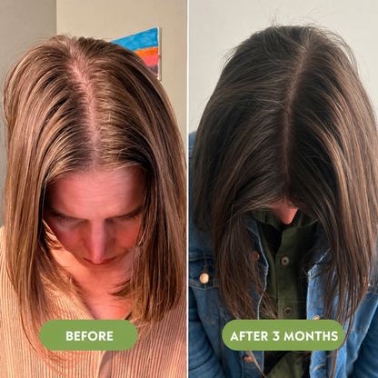 🔥Buy 2 Get 1 FREE + Free Shipping 🔥Advanced Hair Growth Serum