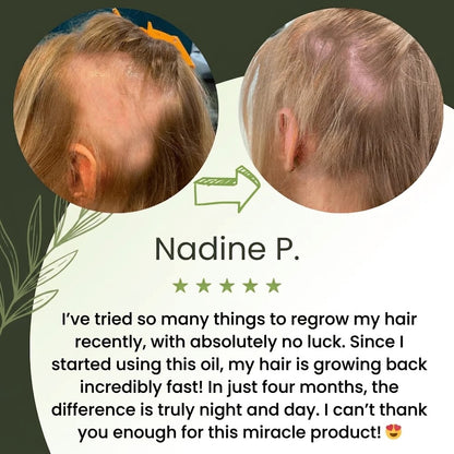 🔥Buy 2 Get 1 FREE + Free Shipping 🔥Advanced Hair Growth Serum